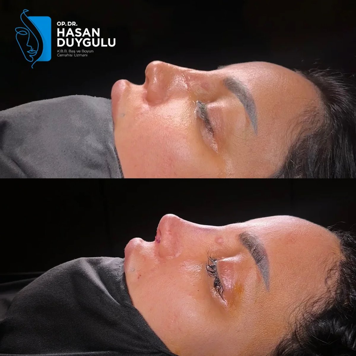 Resultados de septoplastia antes y después en Dr. Hasan Duygulu, perfil nasal mejorado