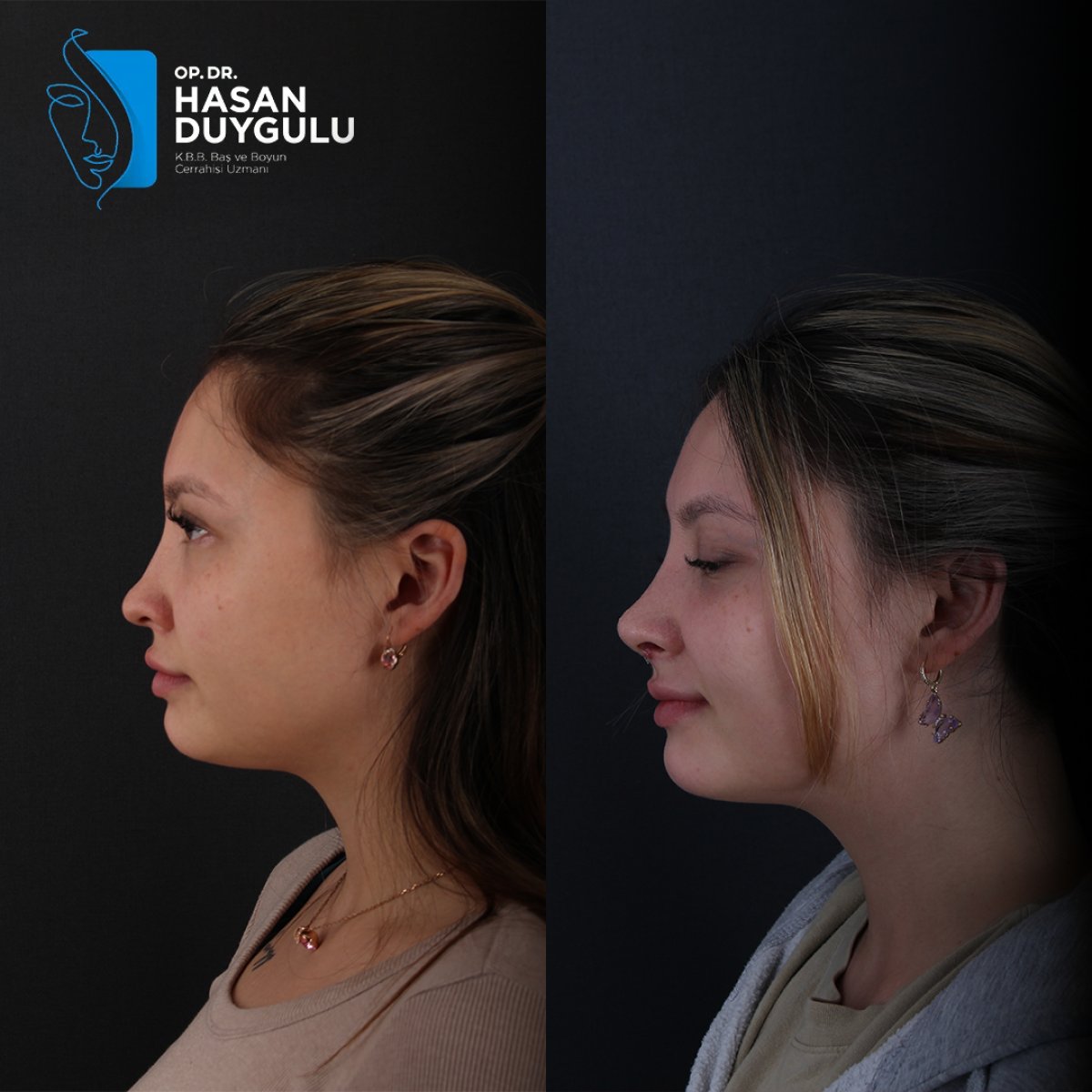 Before and after septoplasty results at Dr. Hasan Duygulu Private Practice for deviated septum