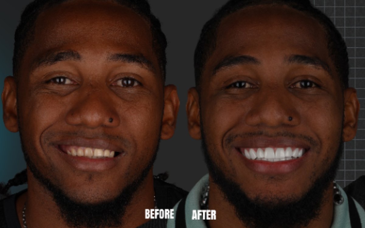 Before and after dental implant results at Esnan Dental Clinics – improved smile aesthetics