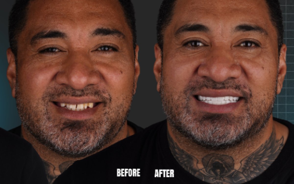 Before and after dental implant results at Esnan Dental Clinics, restored smile transformation
