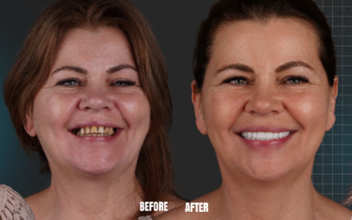 Before and after All-on-4 dental implants result at Esnan Dental Clinics, improved smile