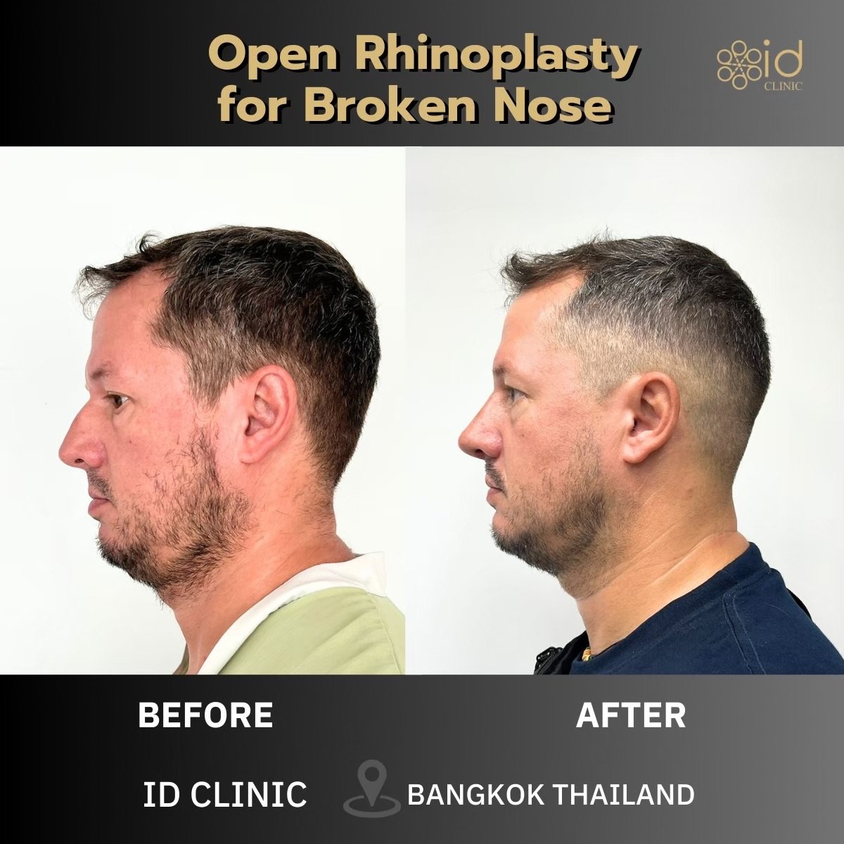 Antes y después de rinoplastia abierta por nariz rota en ID Clinic Bangkok, resultado visible