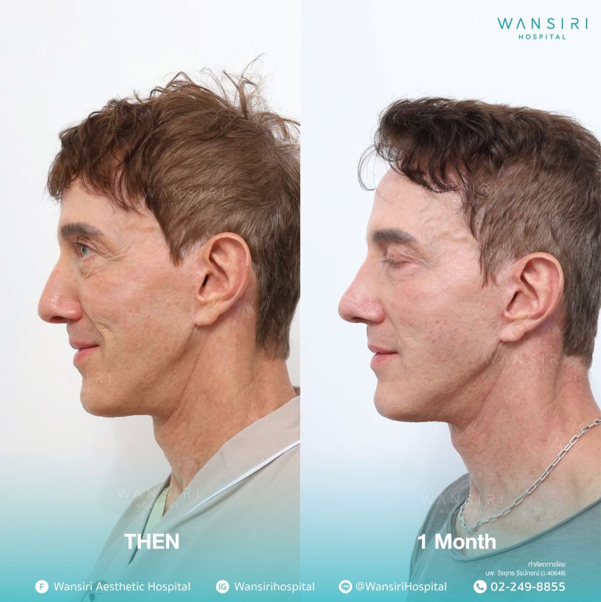 before and after photo