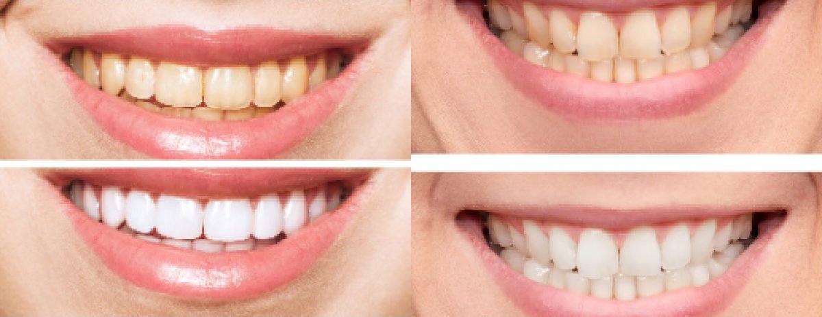 before and after photo