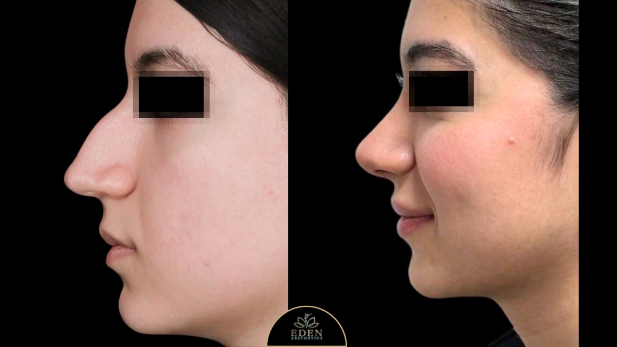 نتائج تجميل الأنف قبل وبعد في EDEN AESTHETICS، إعادة تشكيل الأنف بمظهر طبيعي