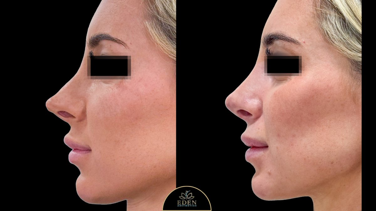 نتائج عملية تجميل الأنف قبل وبعد في EDEN AESTHETICS، إعادة تشكيل الأنف بمظهر طبيعي