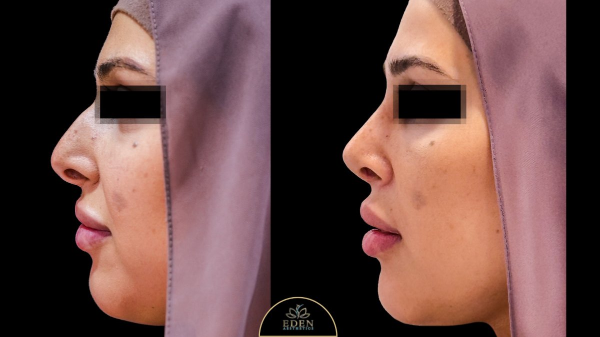 نتائج عملية تجميل الأنف قبل وبعد في EDEN AESTHETICS، تحسين شكل الأنف والملف الجانبي