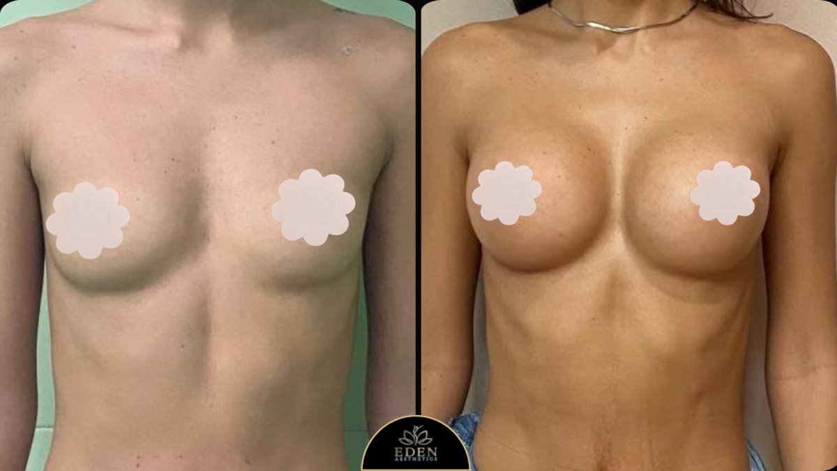 Résultats avant et après augmentation mammaire chez EDEN AESTHETICS, volume accru
