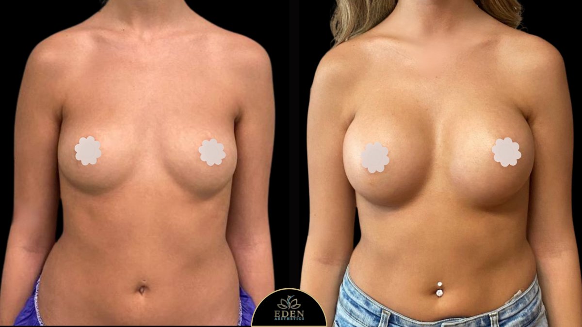 نتائج تكبير الثدي قبل وبعد في EDEN AESTHETICS، زيادة حجم الثدي