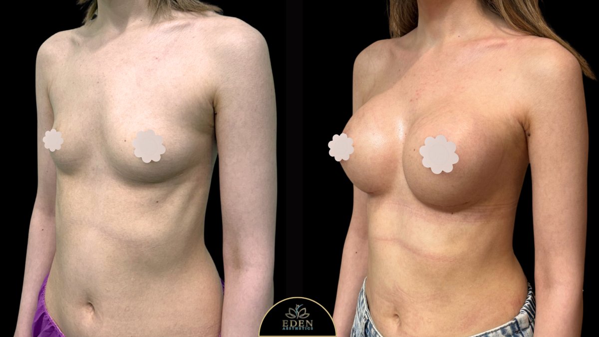 نتائج قبل وبعد تكبير الثدي في EDEN AESTHETICS، زيادة حجم الثدي