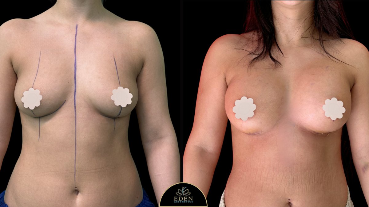 Résultats avant et après augmentation mammaire chez EDEN AESTHETICS, forme améliorée
