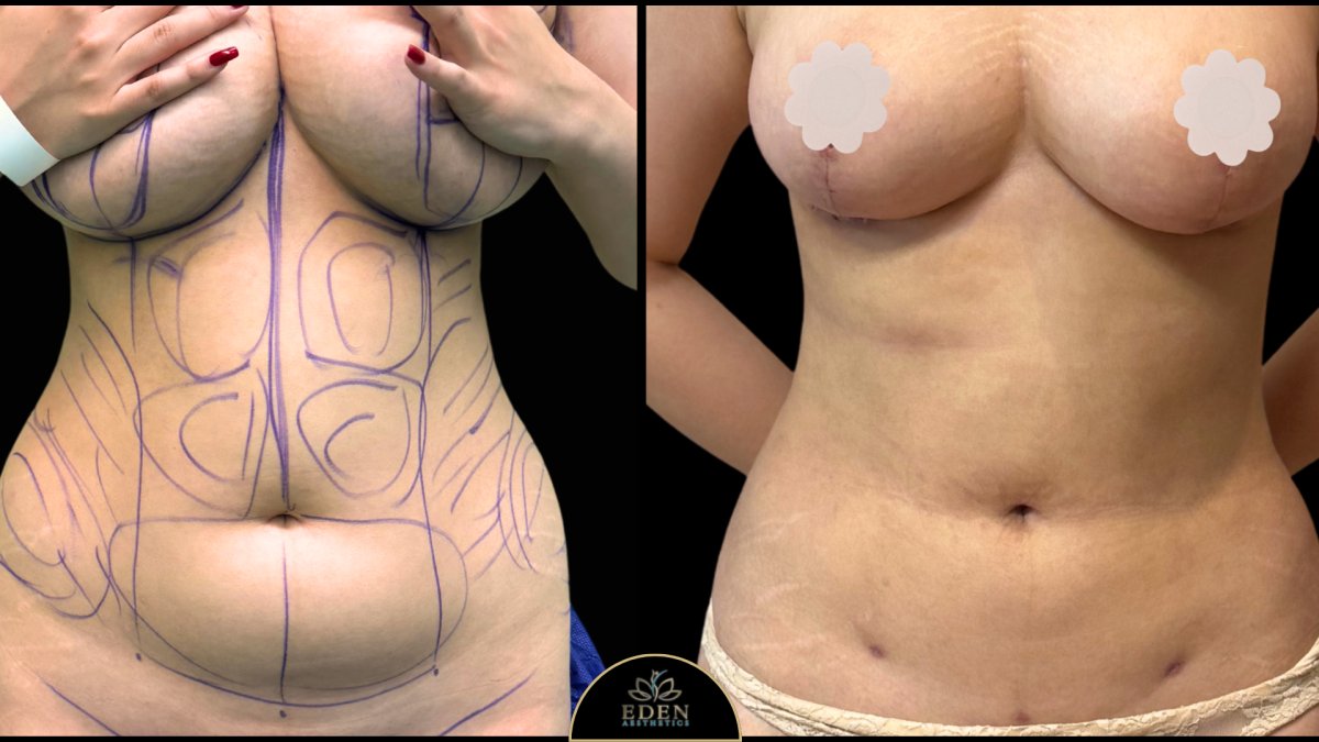 Antes y después de mommy makeover en EDEN AESTHETICS, contorno corporal y levantamiento de senos