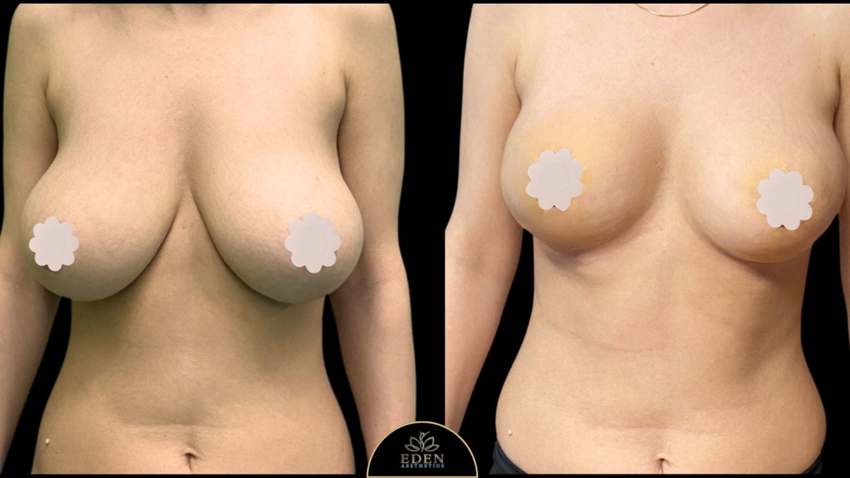 Antes y después de mommy makeover en EDEN AESTHETICS, resultados de levantamiento mamario