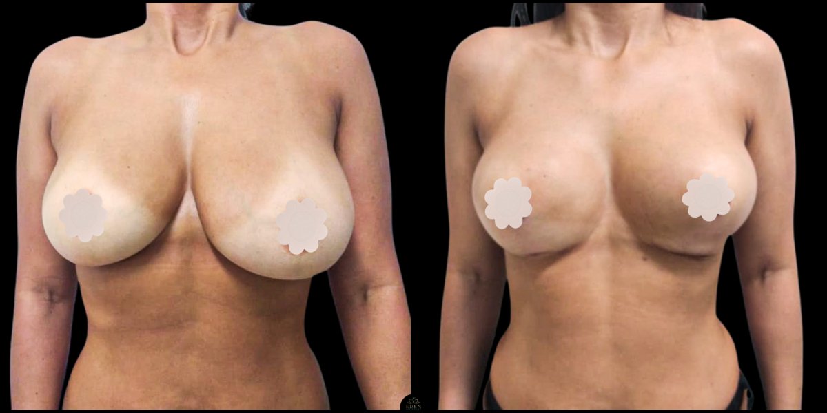 قبل وبعد عملية تجميل الأم في EDEN AESTHETICS، رفع وتحديد واضح للصدر