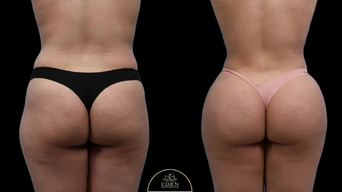 Résultats avant/après Brazilian Butt Lift chez EDEN AESTHETICS – fessier amélioré