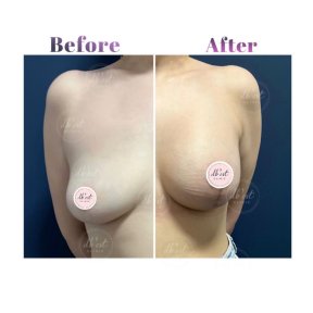 Breast Augmentation with Silicone Implants Surgery - photo 6
