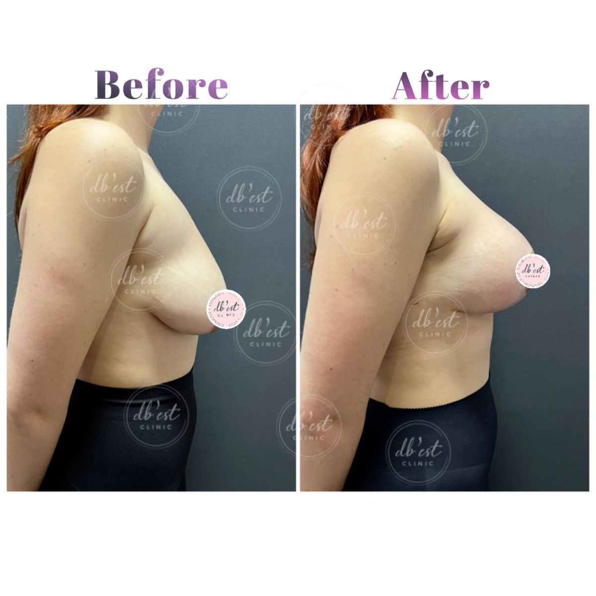 Before and after breast augmentation results at Db'est Clinic, enhanced breast shape