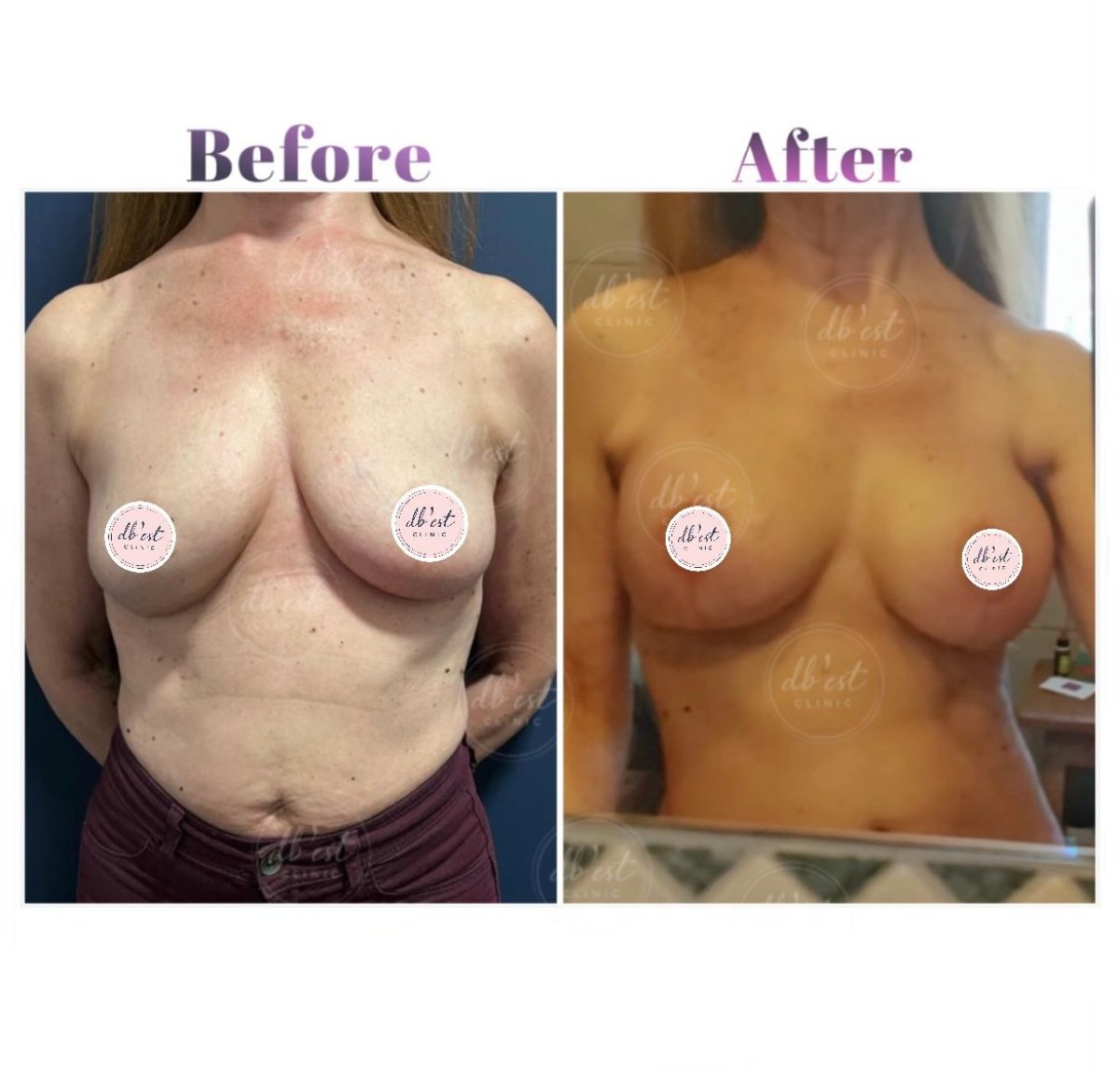 Antes y después de aumento de senos en Db'est Clinic, mejor forma y simetría mamaria