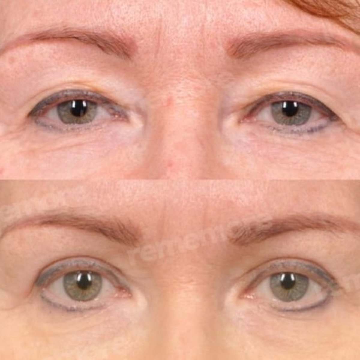 Before and after upper and lower eyelid surgery results at Memorial Bahçelievler Hospital