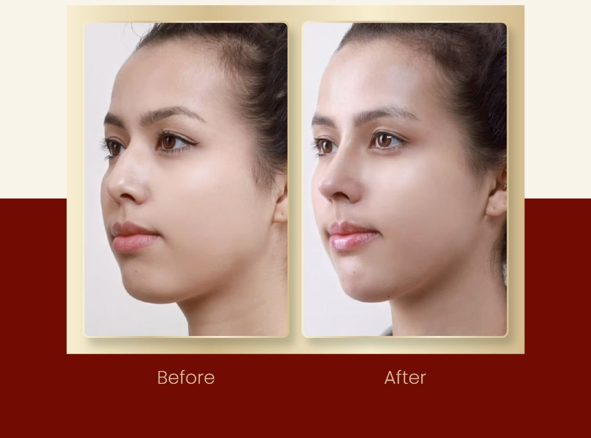 Before and after septoplasty results at DGB Clinic, improved nasal symmetry and breathing