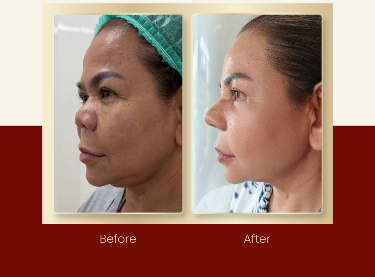 Resultados de septoplastia antes y después en DGB Clinic, mejor perfil nasal y respiración