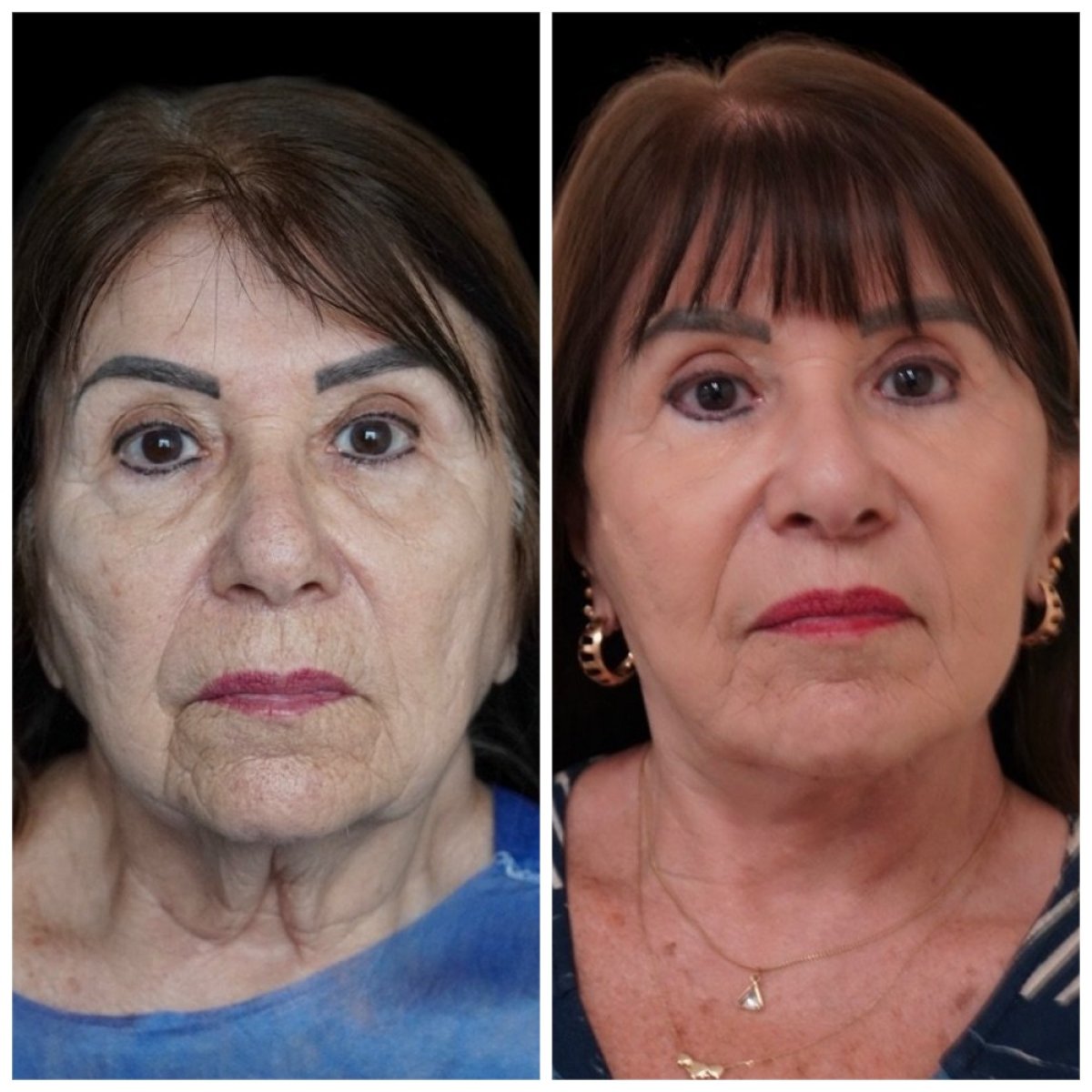 Resultados de blefaroplastia antes y después en Dr. Michel Salameh - Plastic And Aesthetic Surgery