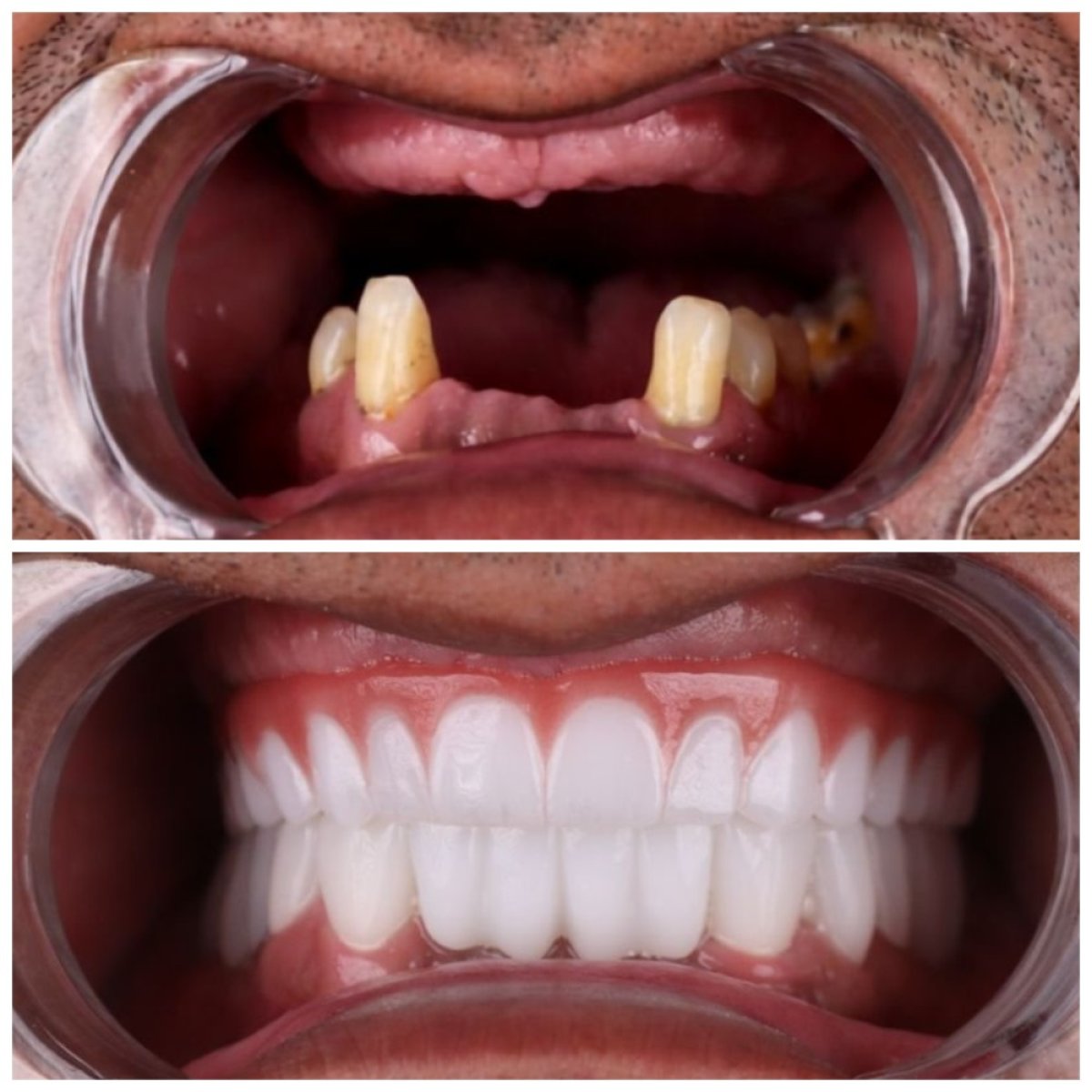 Before and after All-on-4 dental implants result at TH Dental Clinic, full smile restoration