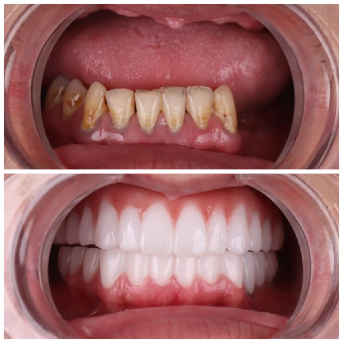 Before and after All-on-4 dental implants result at TH Dental Clinic, full smile restoration