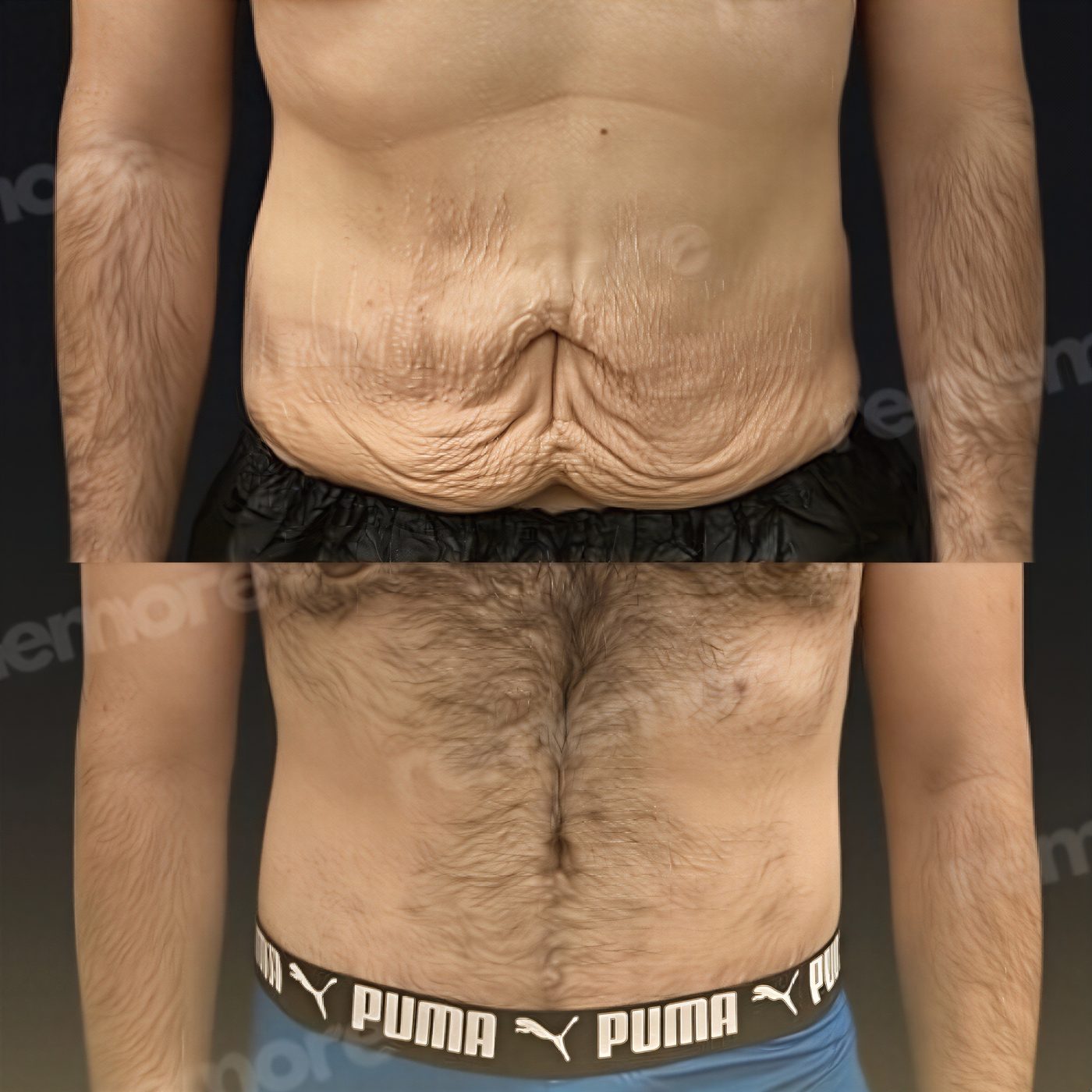 Resultados de abdominoplastia antes y después en Memorial Şişli Hospital, abdomen mejorado