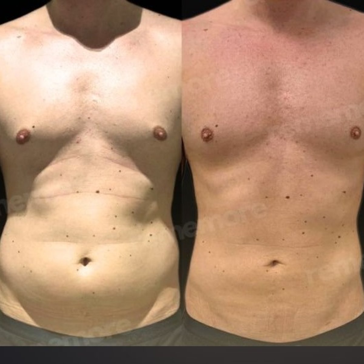 Before and after tummy tuck results at Memorial Şişli Hospital, visible abdominal contouring