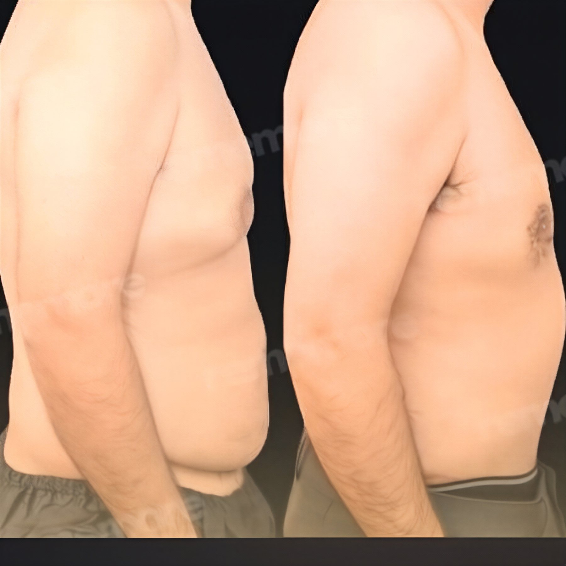 Resultados de abdominoplastia antes y después en Memorial Şişli Hospital, abdomen más plano
