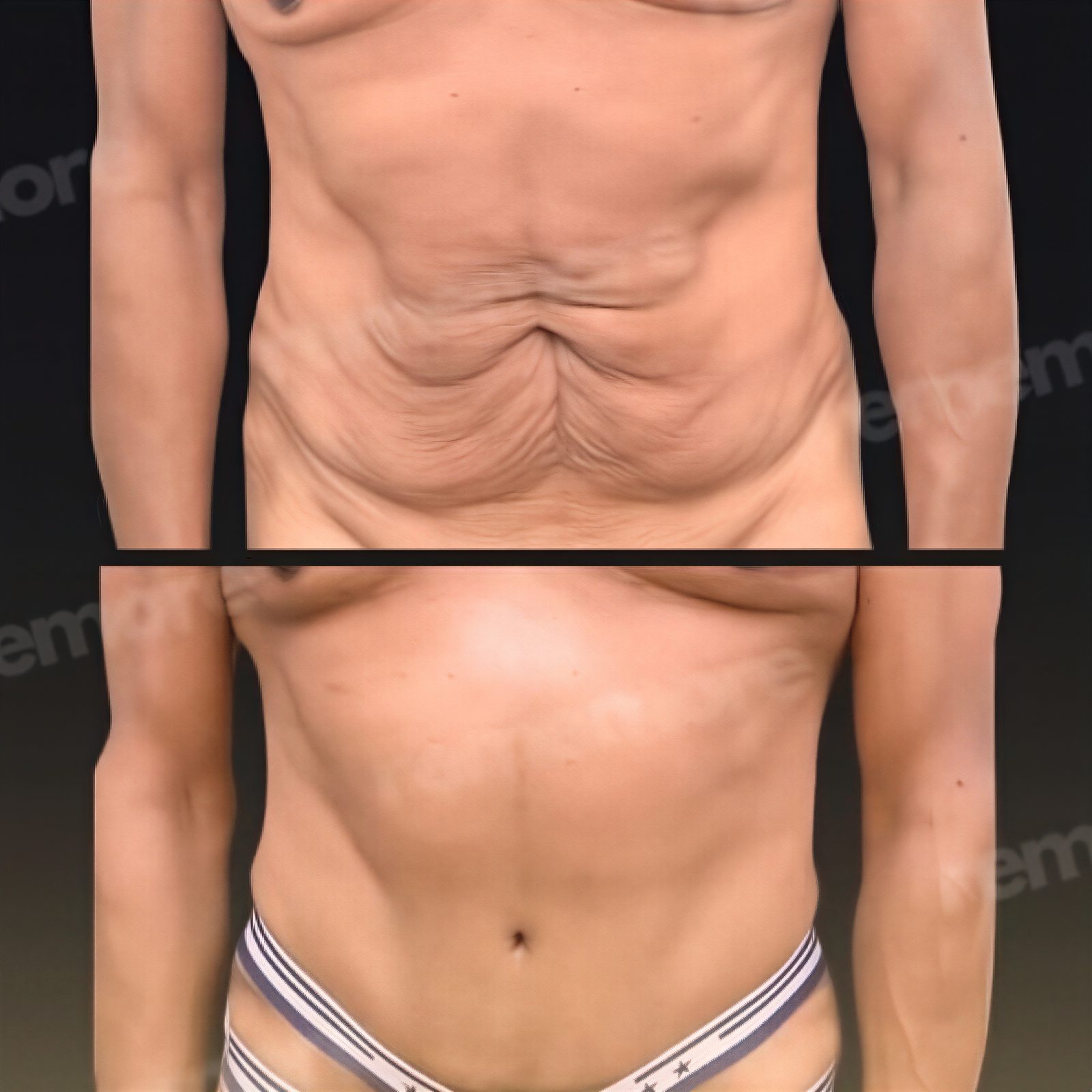 Resultados de abdominoplastia antes y después en Memorial Şişli Hospital, mejor contorno abdominal