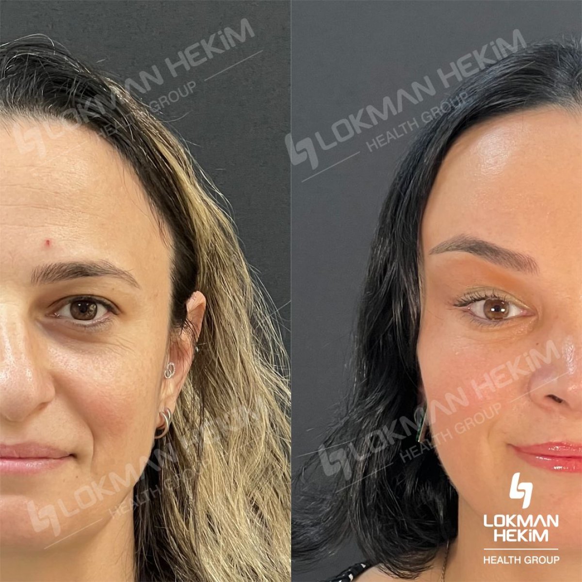 До та після ліпофілінгу обличчя в Lokman Hekim Istanbul Hospital, результат омолодження