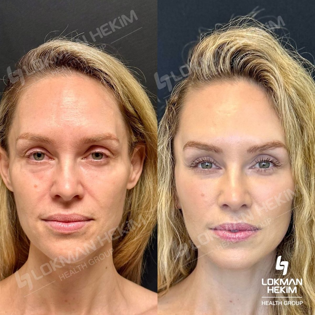 Vorher-nachher-Ergebnis des Facial Fat Transfer in Lokman Hekim Istanbul Hospital, Verjüngung