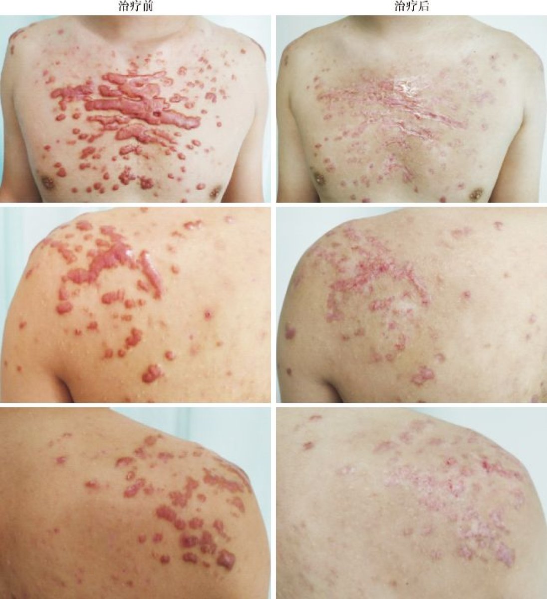 Resultados antes y después de cirugía de cicatrices queloides en Xiamen Humanity Hospital