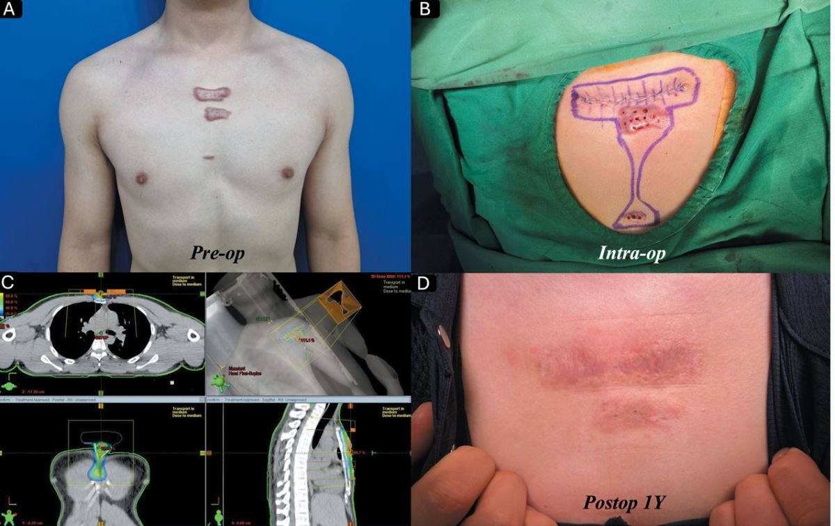 Resultados de corrección de cicatrices en piel antes y después en el pecho en Xiamen Humanity Hospital