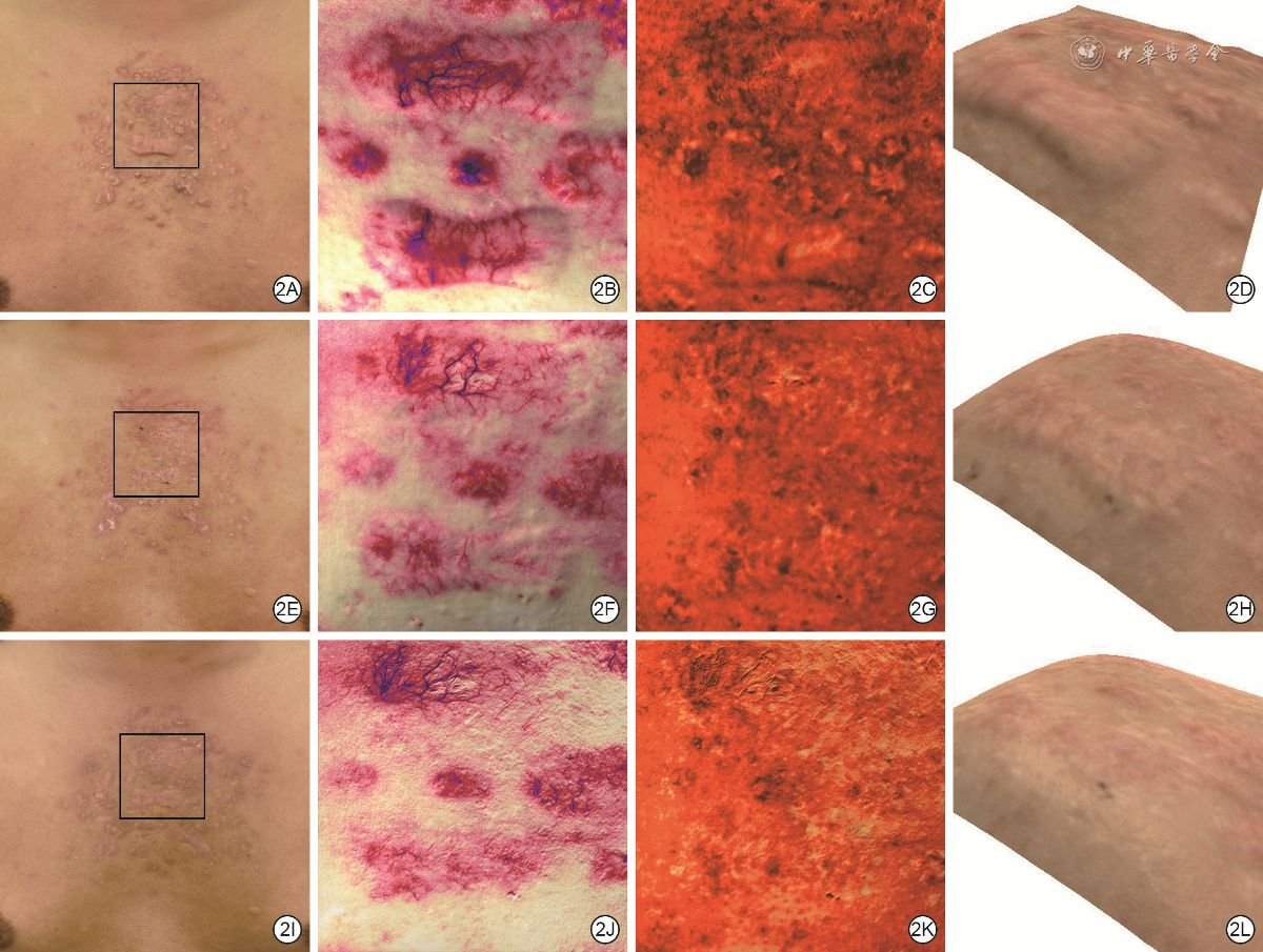 Resultados antes y después de cirugía de piel para cicatrices de acné en Xiamen Humanity Hospital, mejora visible