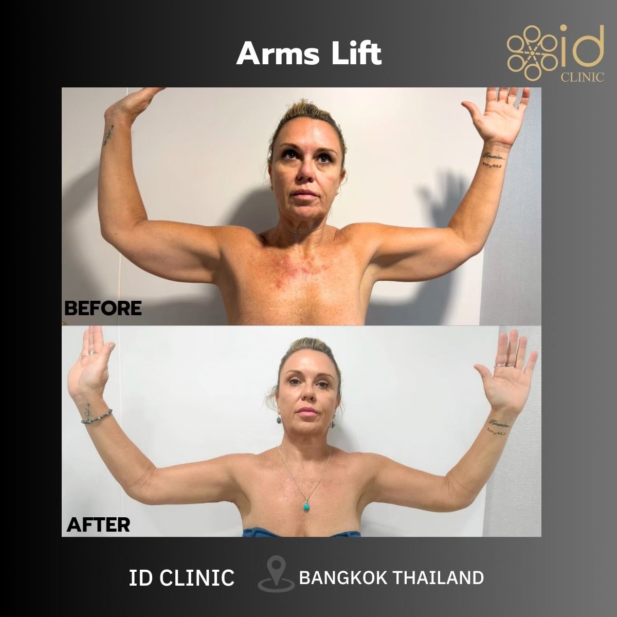 Resultados antes y después de lifting de brazos en ID Clinic Bangkok, mejor contorno y firmeza