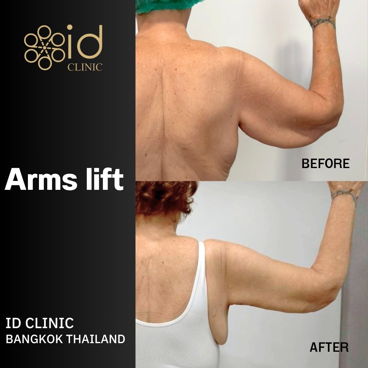 Resultados de lifting de brazos antes y después en ID Clinic Bangkok, contorno mejorado