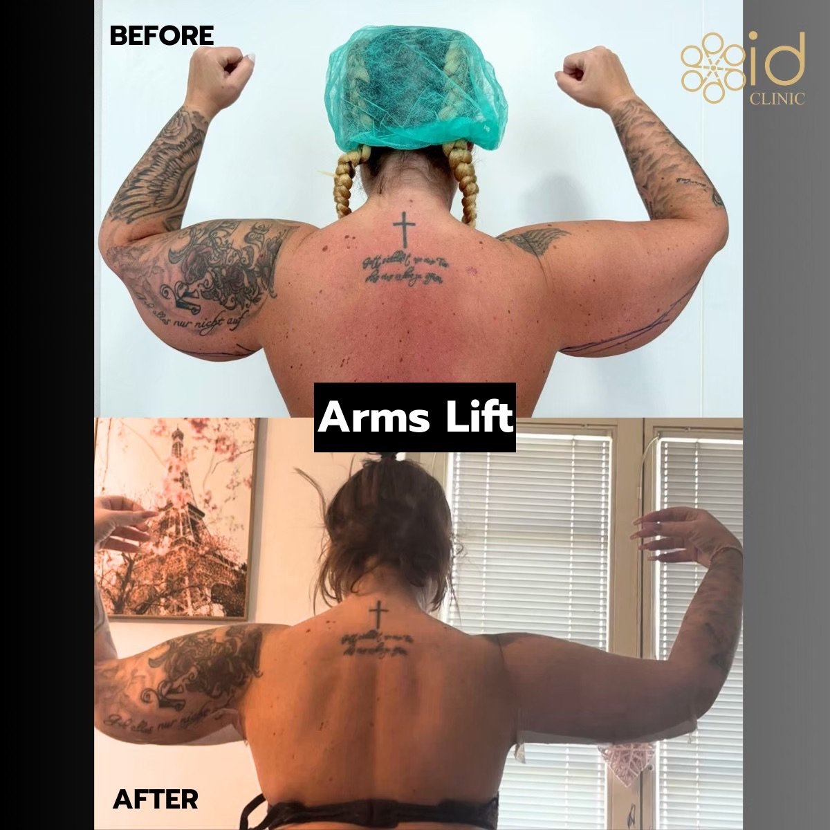 Before and after arm lift results at ID Clinic Bangkok, improved arm contour and firmness