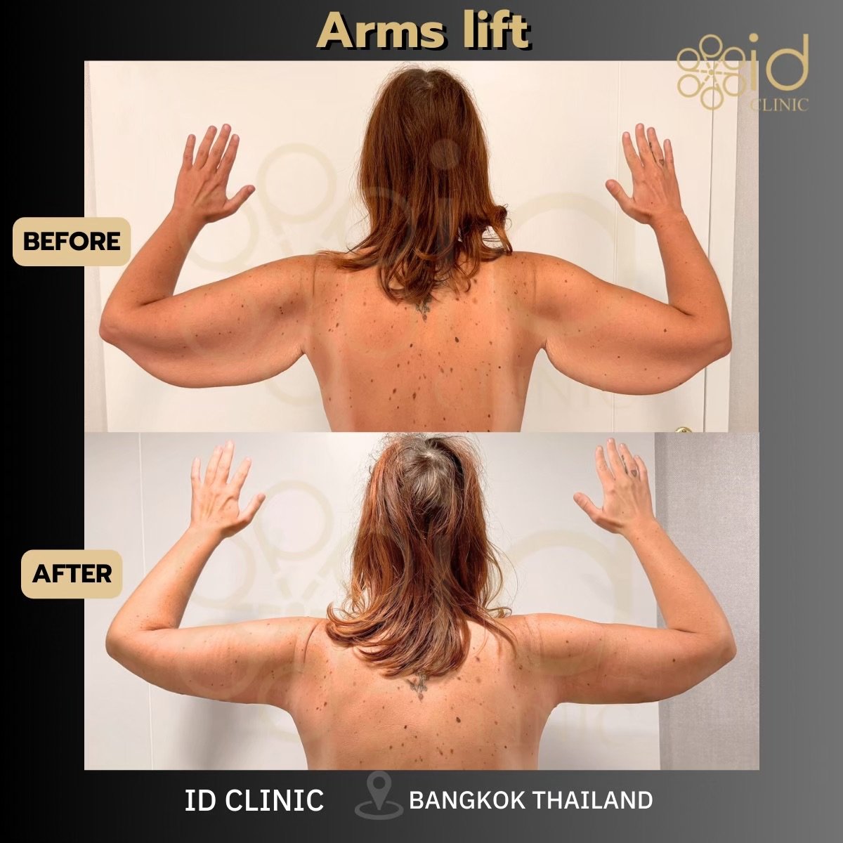 Resultados de lifting de brazos antes y después en ID Clinic Bangkok con mejor contorno