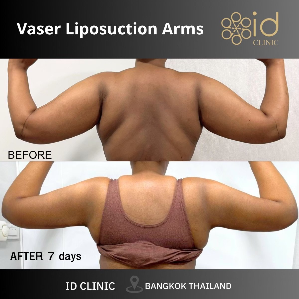 Resultados antes y después de liposucción Vaser de brazos en ID Clinic Bangkok, brazos más delgados