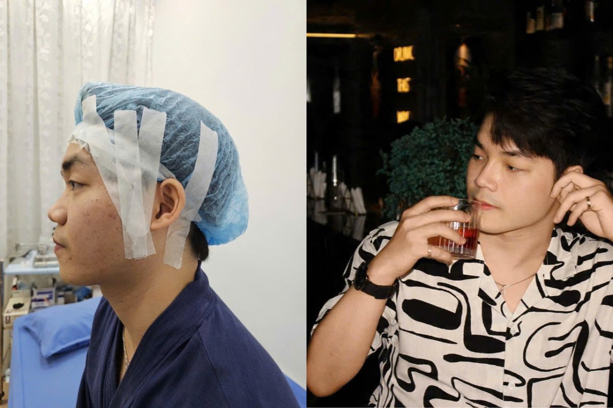 Before and after rhinoplasty results at Doctor International Aesthetics, improved nose profile