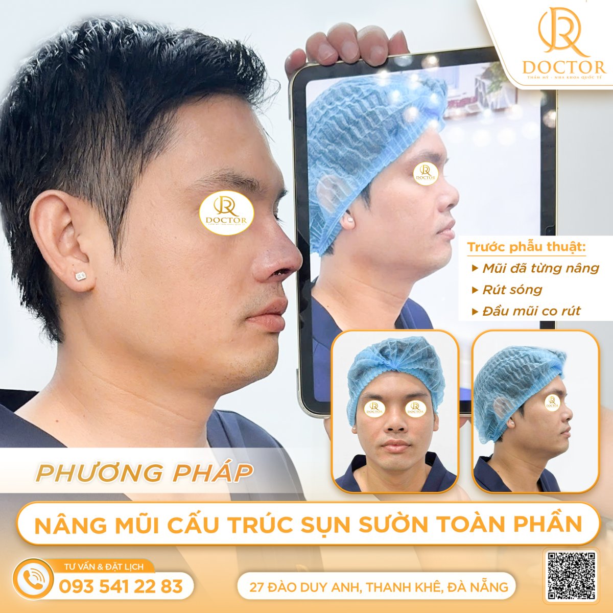 Before and after rhinoplasty results at Doctor International Aesthetics, improved nose profile