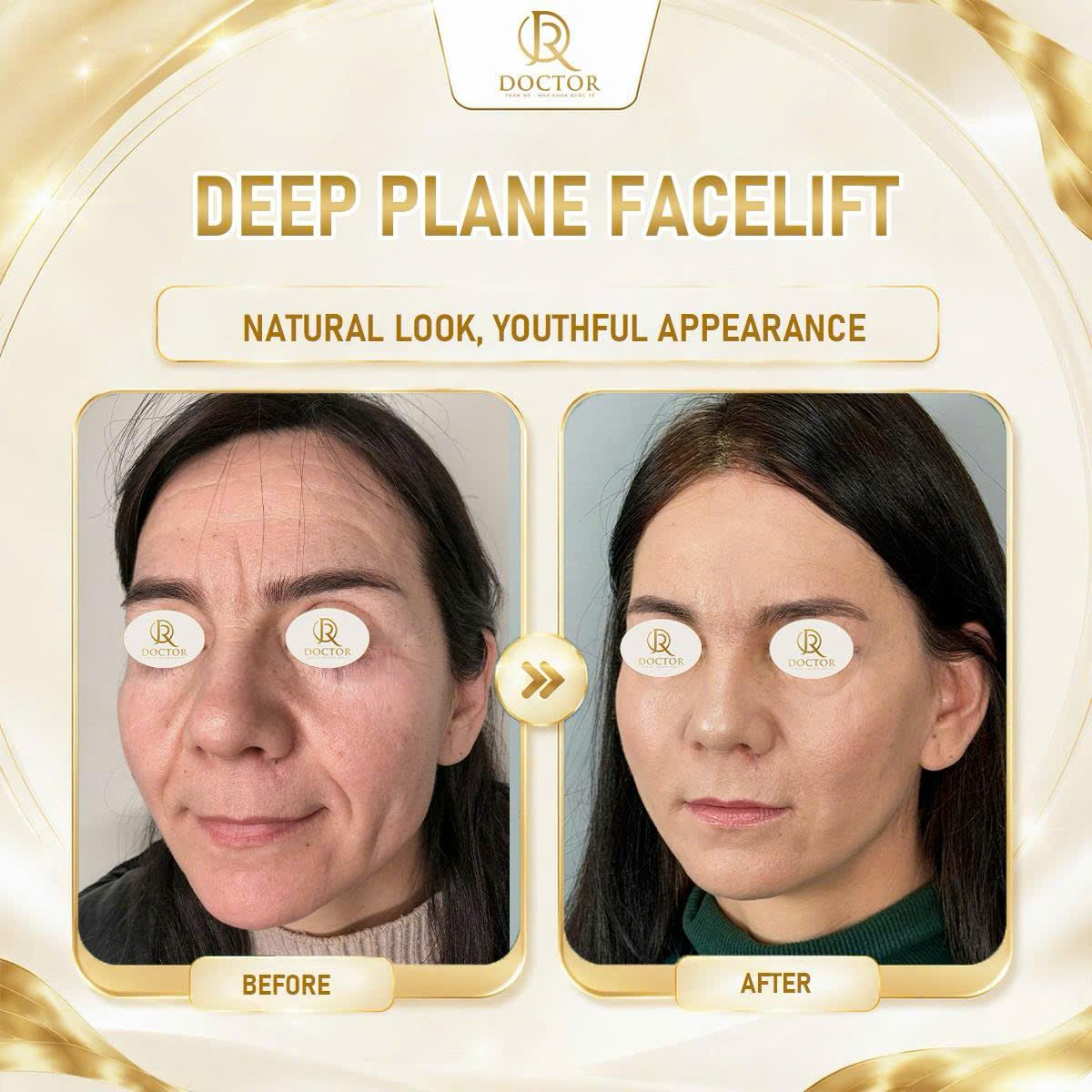 Before and after deep plane facelift results at Doctor International Aesthetics, youthful look