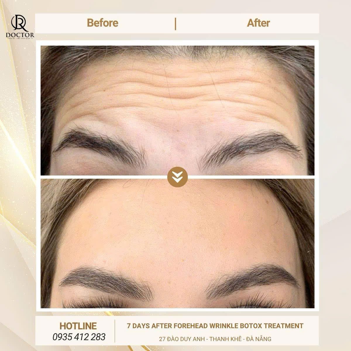 Before and after Botox for forehead wrinkles at Doctor International Aesthetics, smooth result