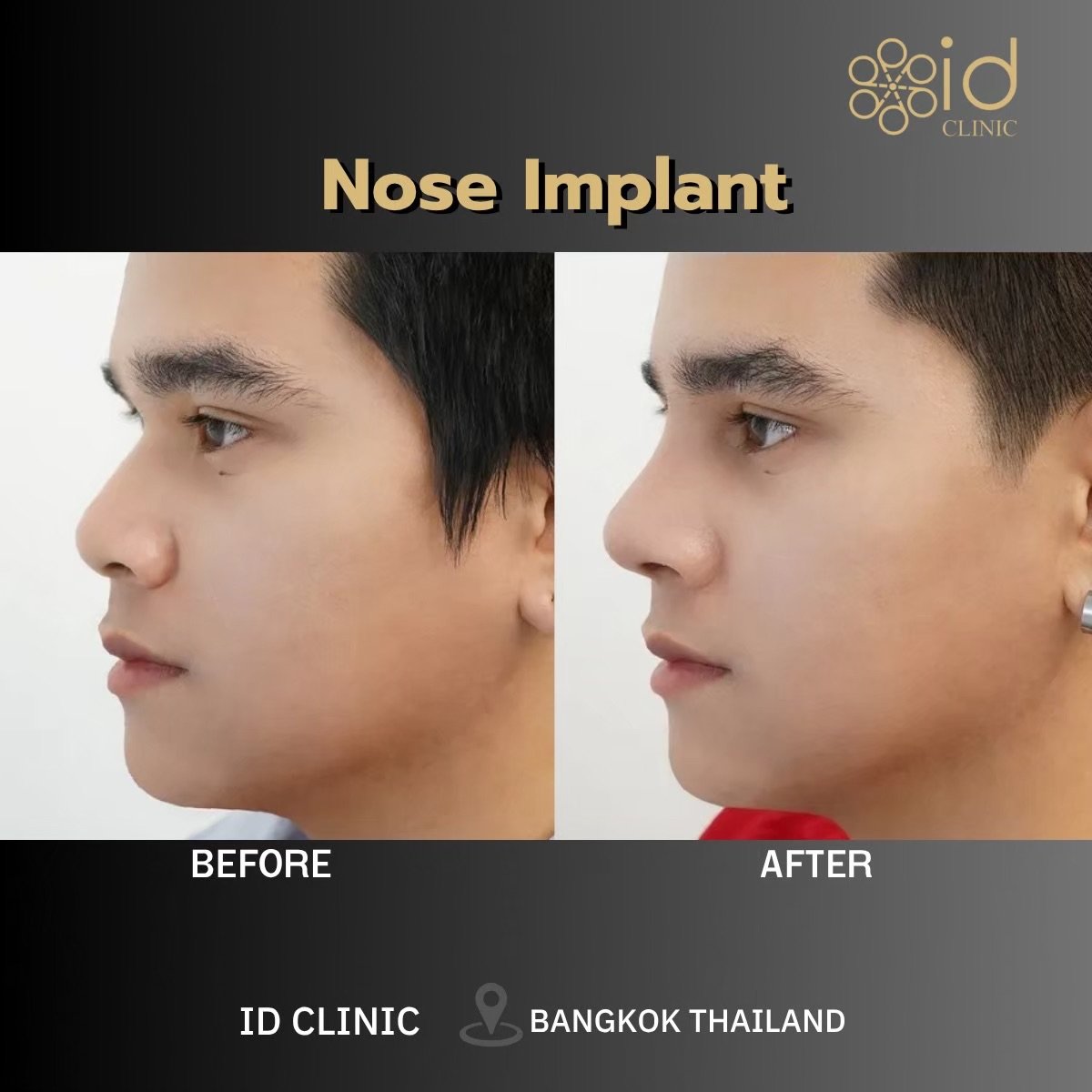 Resultados antes y después de implante nasal en ID Clinic Bangkok, perfil de nariz mejorado