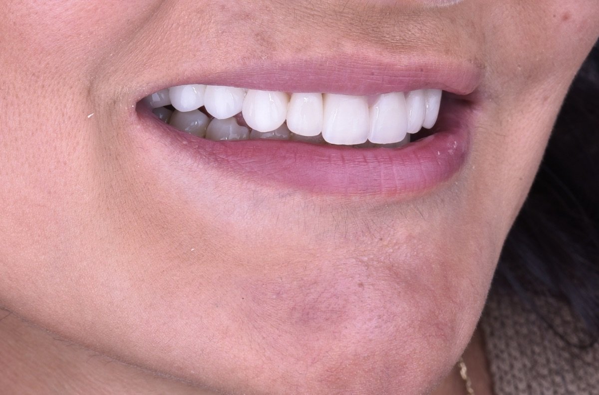 نتيجة زراعة الأسنان في Dentaland Premium Luxury Clinic & Academy – ابتسامة طبيعية مستعادة