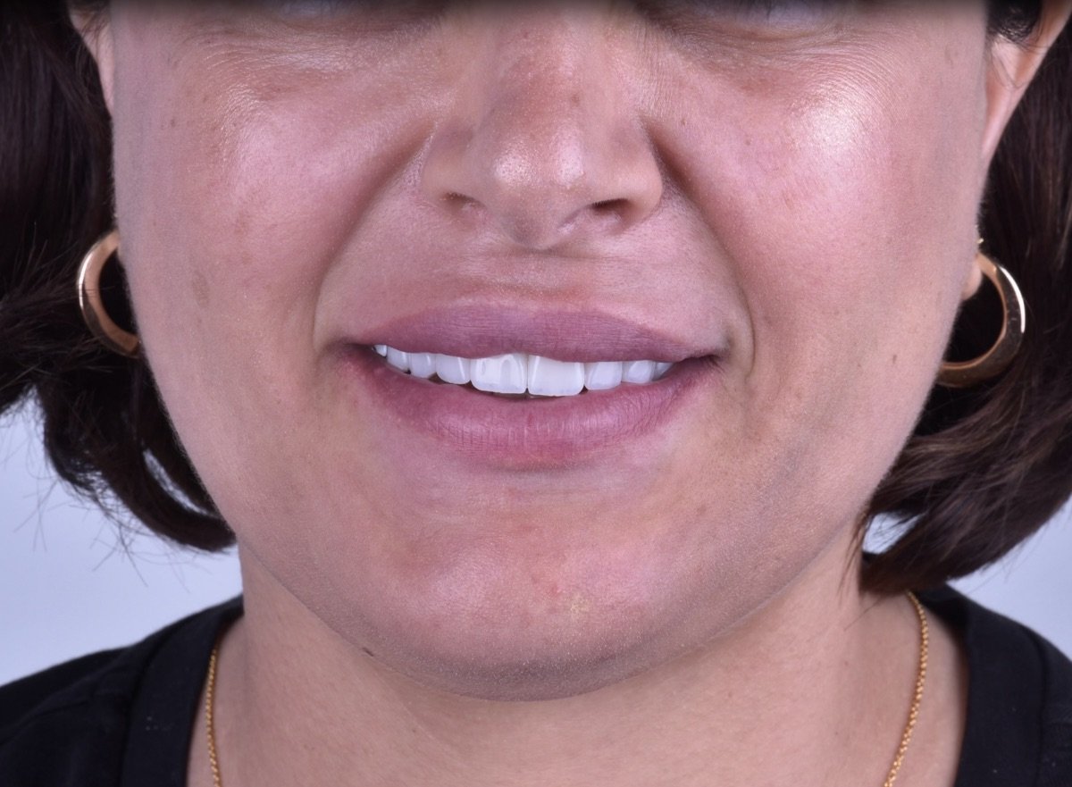 نتيجة زراعة الأسنان في Dentaland Premium Luxury Clinic & Academy، ابتسامة طبيعية مستعادة