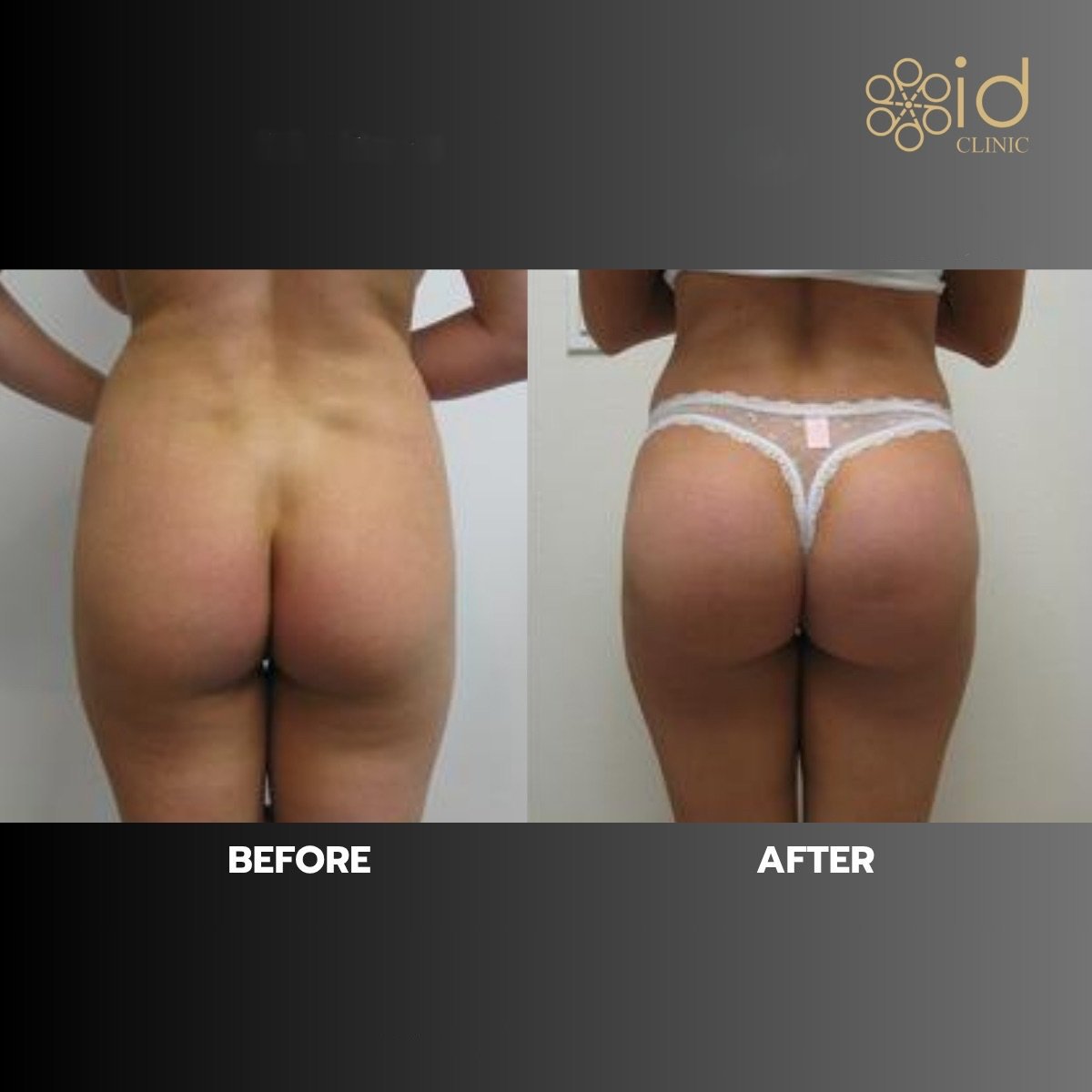 Antes y después de implantes de glúteos en ID Clinic Bangkok, resultado de contorno mejorado